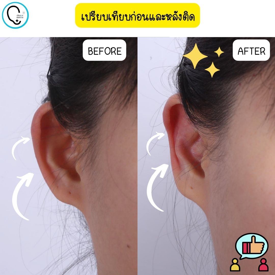 พร้อมส่งจากไทย แก้ปัญหาหูกางด้วย Ear flat ปรับปรุงใหม่เนียนใส/บางกว่าเดิม ใช้คู่กับกาวรียูส(ตัวแทนจำหน่ายในไทย)_OP017
