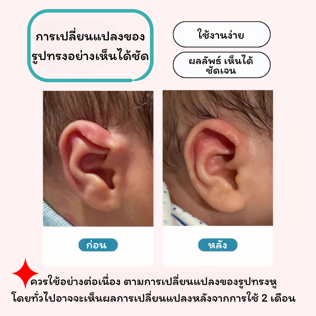 Flat Stick ก้านซิลิโคนปรับรูปทรงหู สำหรับเด็ก แก้ไขปัญหาใบหูพับ / ผิดรูป_OP039