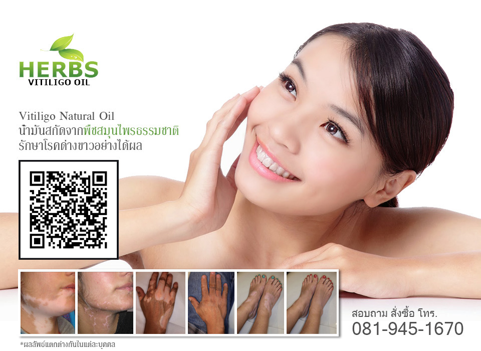 vitiligo oil รักษาโรคด่างขาวด้วยน้ำมันสกัดจากพืชสมุนไรธรรมชาติ