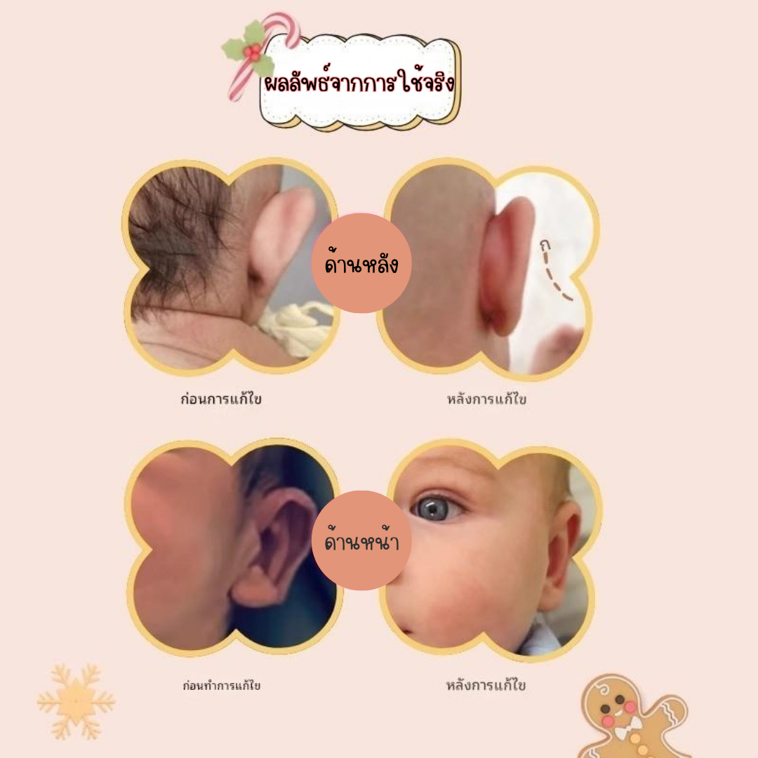 พร้อมส่งจากไทย แก้ปัญหาหูกางด้วย Ear flat ปรับปรุงใหม่เนียนใส/บางกว่าเดิม ใช้คู่กับกาวรียูส(ตัวแทนจำหน่ายในไทย)_OP017