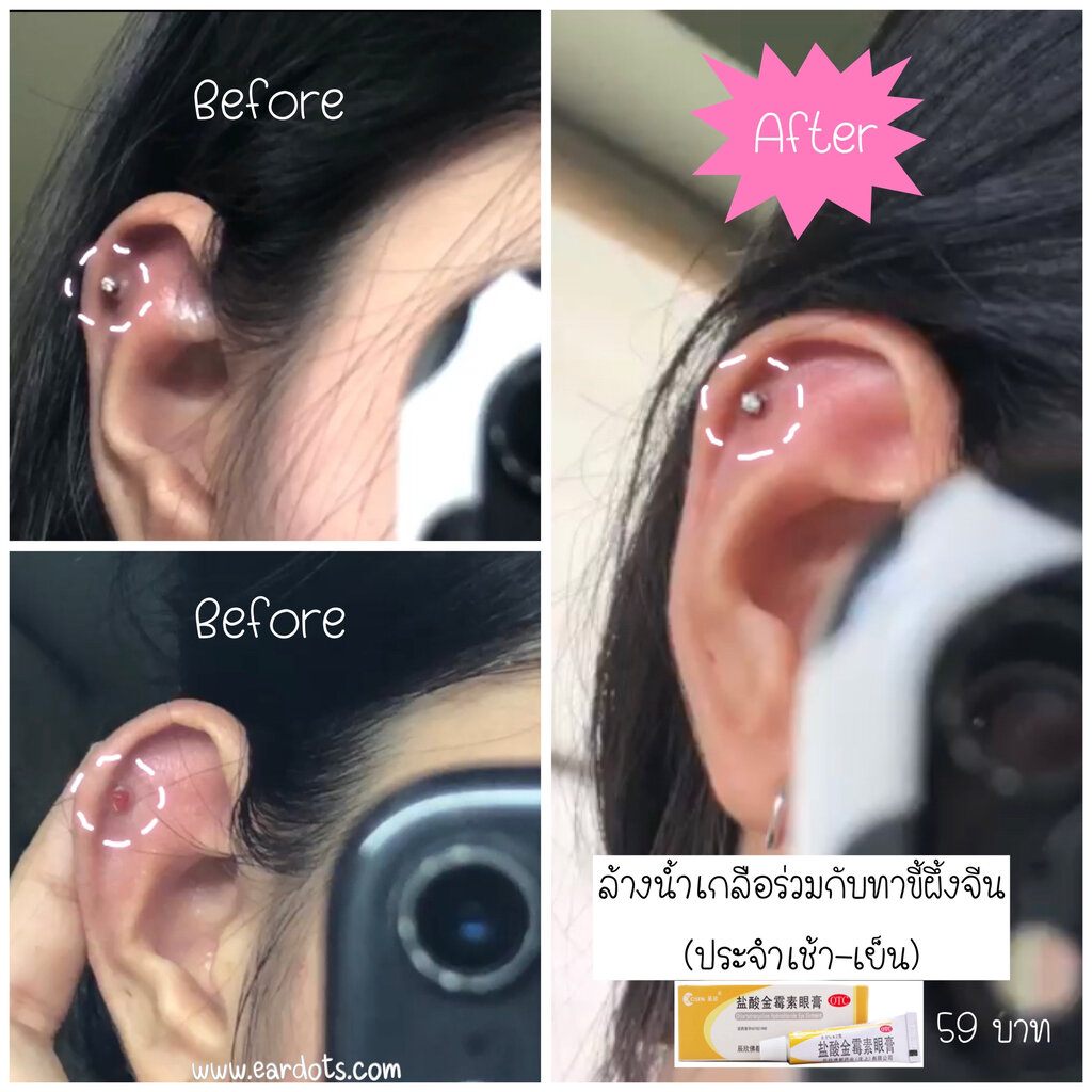 *กดติดตามมีส่วนลด* เจาะหู/จมูก/สะดือ/คิ้ว/ปากอักเสบต้องมี!!! ขี้ผึ้งจีนโบราณสมานแผล (ป้องกัน/รักษาแผลอักเสบจากเจาะ หายเร็วขึ้น)_OP007