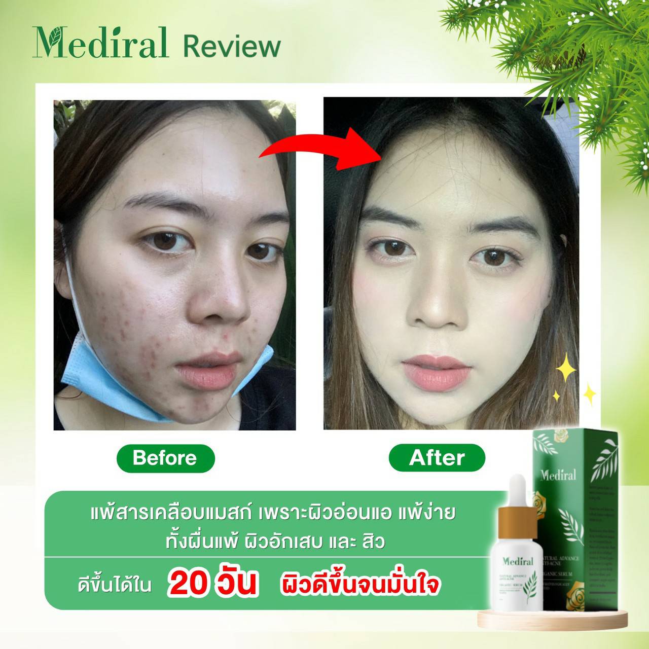 Mediral เซรั่มปราบสิว ผิวนุ่มชุ่มชื้น Natural Advance Anti Acne ชิ้น