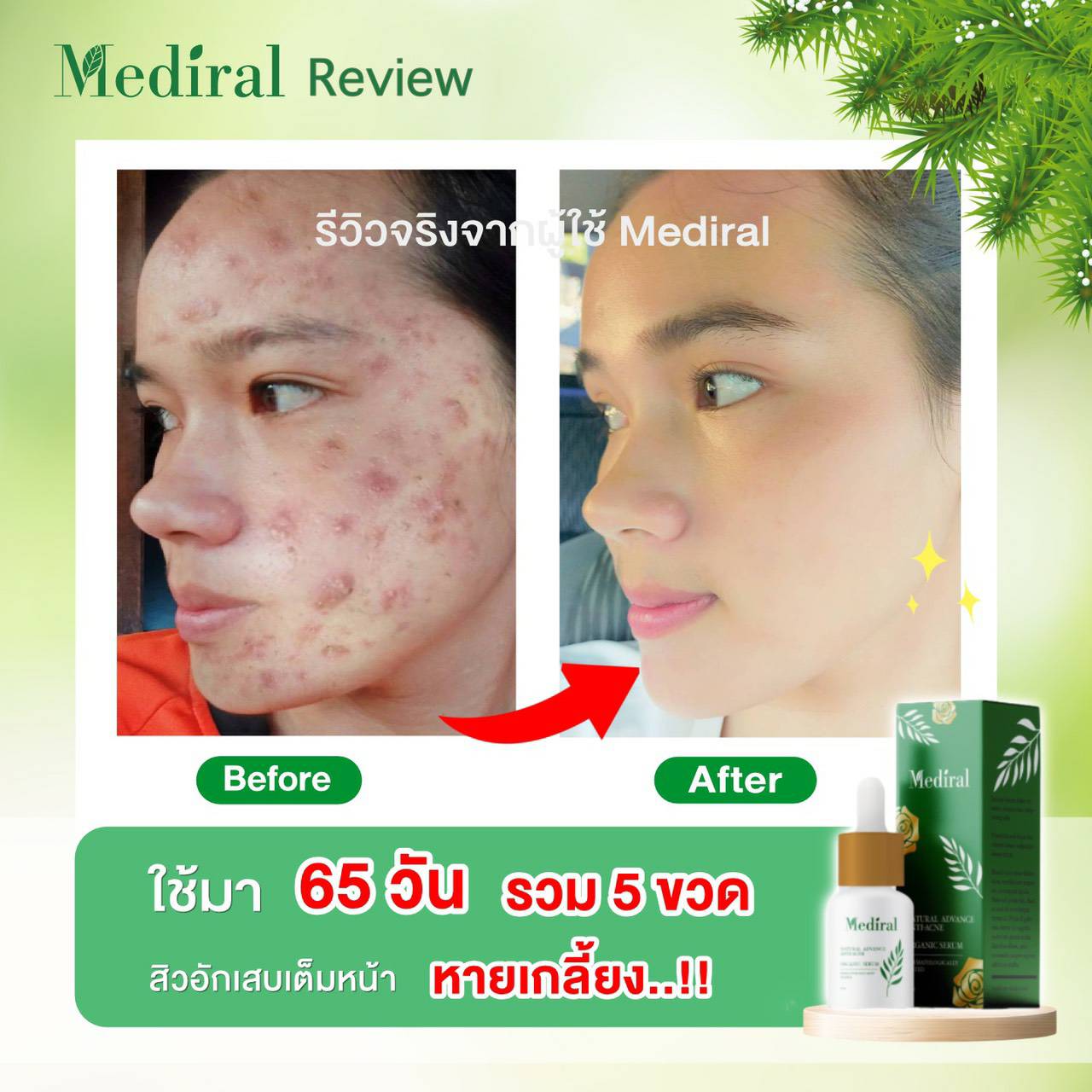 Mediral เซรั่มปราบสิว ผิวนุ่มชุ่มชื้น Natural Advance Anti Acne ชิ้น
