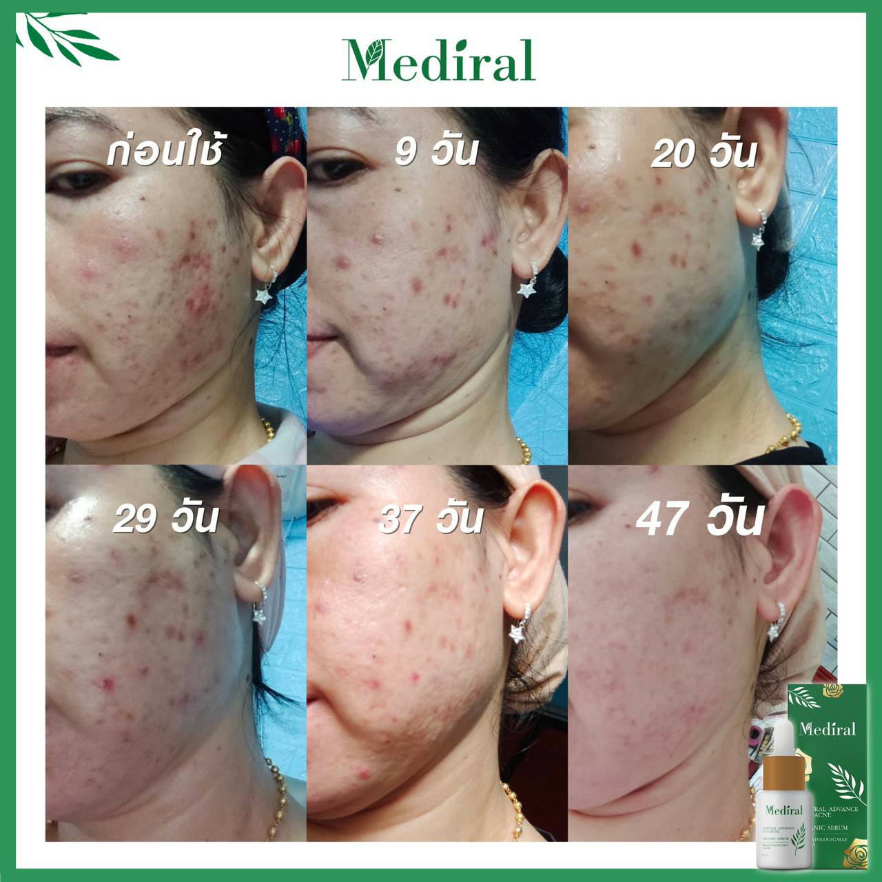 Mediral เซรั่มปราบสิว ผิวนุ่มชุ่มชื้น Natural Advance Anti Acne ชิ้น