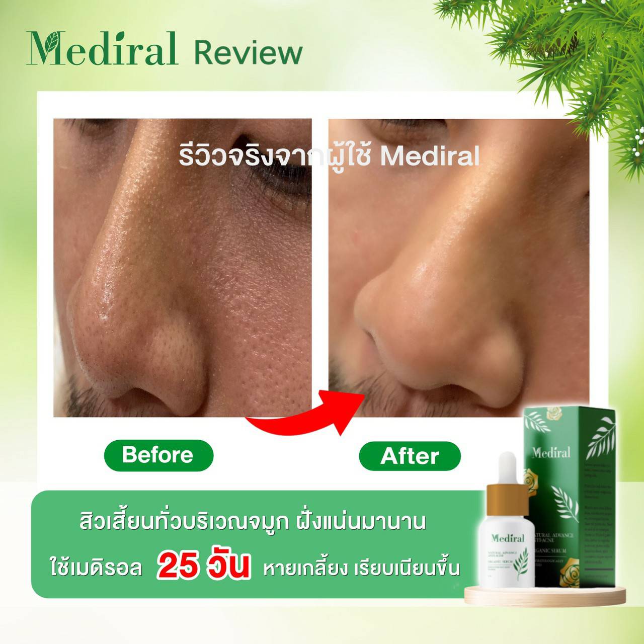 Mediral เซรั่มปราบสิว ผิวนุ่มชุ่มชื้น Natural Advance Anti Acne ชิ้น