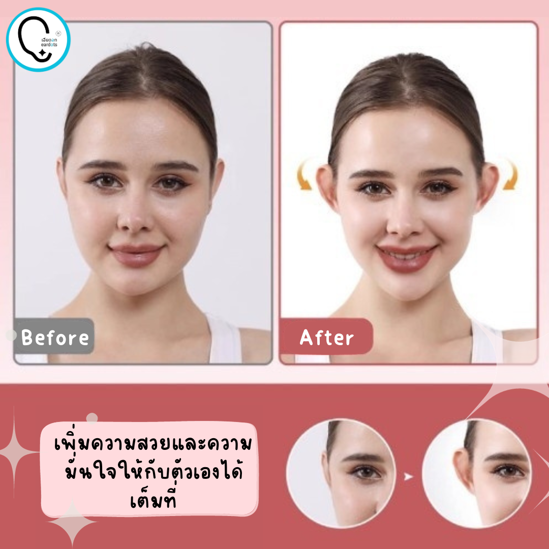 แผ่นติดทำให้หูกาง ดูมีมิติ ไม่ลีบแบน ELF EAR STRIPS