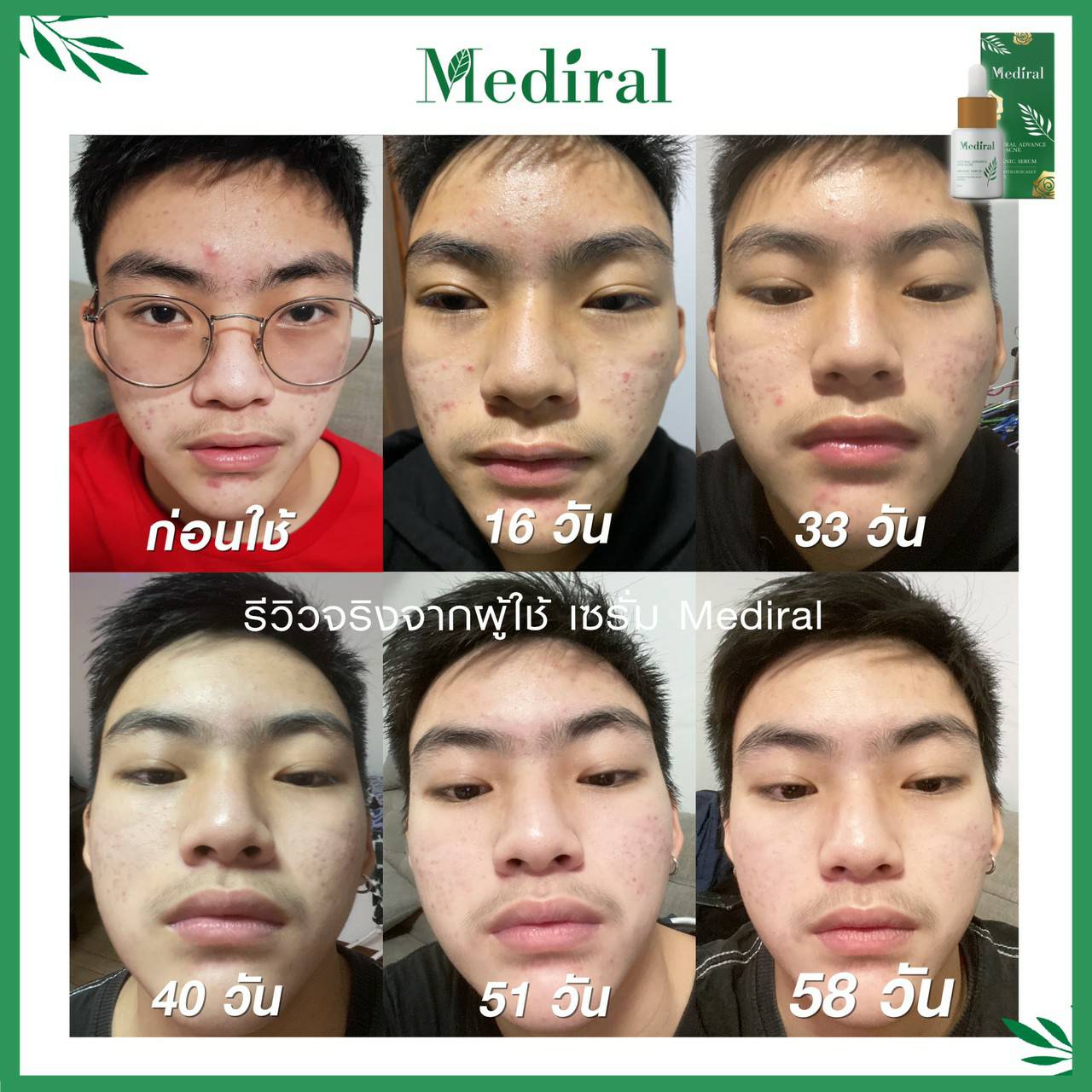 Mediral เซรั่มปราบสิว ผิวนุ่มชุ่มชื้น Natural Advance Anti Acne ชิ้น
