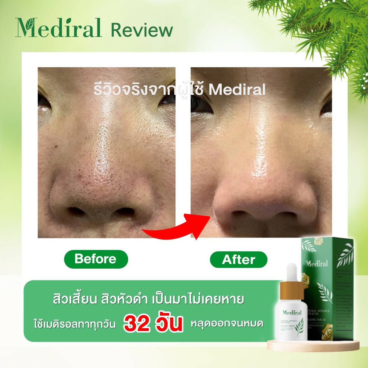 Mediral เซรั่มปราบสิว ผิวนุ่มชุ่มชื้น Natural Advance Anti Acne ชิ้น