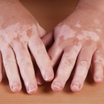 ความรู้เรื่องโรคด่างขาว 3 ชนิดที่สามารถพบได้ทุกเพศทุกวัยทั้งชายและหญิง