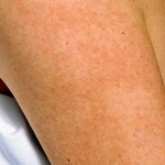 4 เทคนิคง่าย ๆ ในการกำจัดขนคุดที่รักแร้ไม่ให้เหลือแม้แต่รากของขนที่ได้ผลสุด ๆ