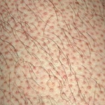 ถอนขนคุดด้วยแหนบ ทำอย่างไร